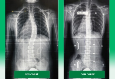93-3_radiografias-escoliosis-y-correccion-con-corse
